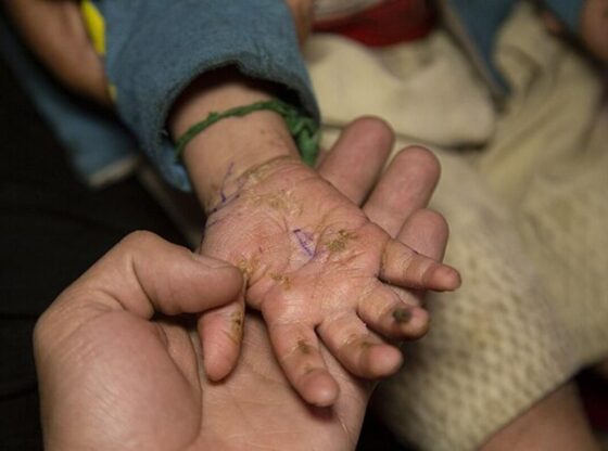 Butterfly Skin has physical symptoms such as blisters and wounds